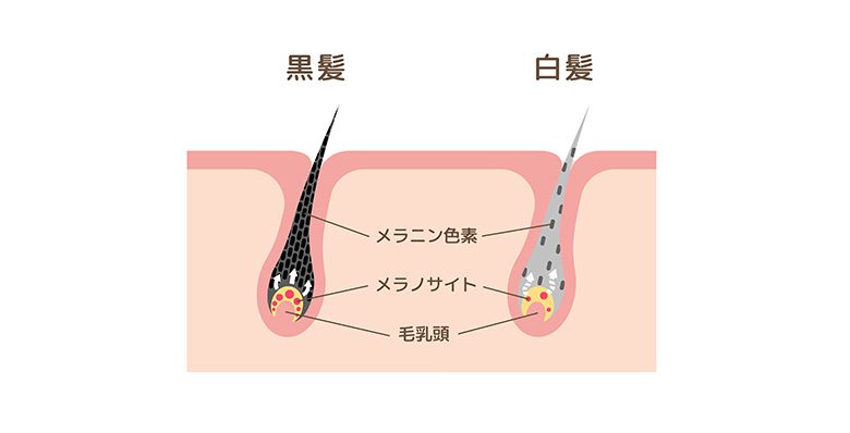 白髪の原因